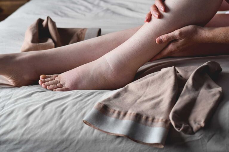 Lymphoedema – symptoms, treatment, and how to reduce your risk