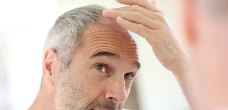 Men's hair loss - causes, treatment and solutions